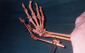 Dynamic External Wrist Fixator