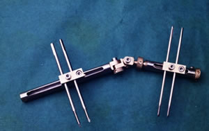 Dynamic External Wrist Fixator