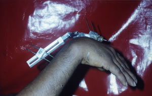 Dynamic External Wrist Fixator