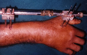 Dynamic External Wrist Fixator